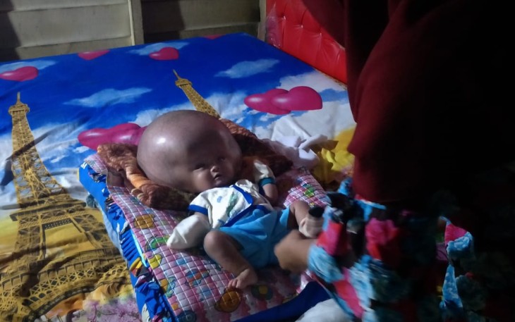 Rehan Saputra Bayi 5 Bulan Penderita Hidrosefalus Butuh Uluran Tangan Dermawan