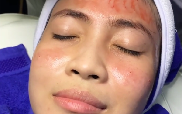 Cara Ampuh Mengatasi Bopeng Bekas Jerawat
