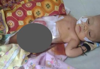 Muhammad Iksan Sayuti Putyra, balita laki-laki usia 4 bulan yang terlahir dengan kondisi kurang beruntung